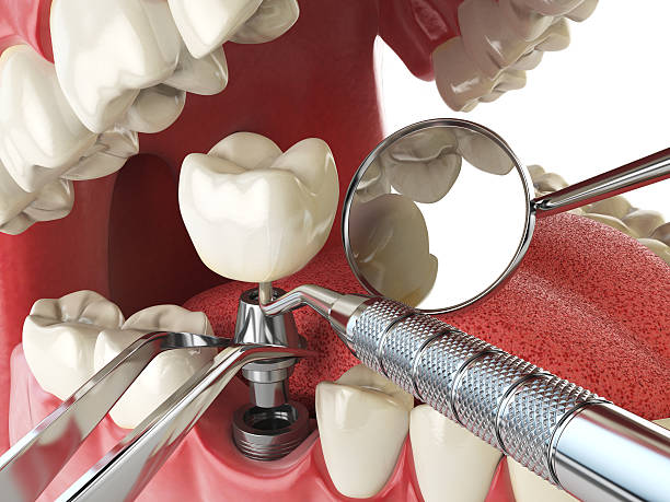 Best Emergency Root Canal Therapy in Chapel Hill, NC